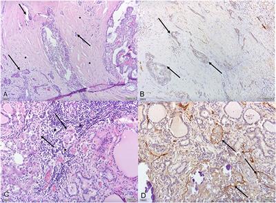 Lymphatic Vessel Invasion in Routine Pathology Reports of Papillary Thyroid Cancer